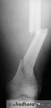 Introduction to Fractures