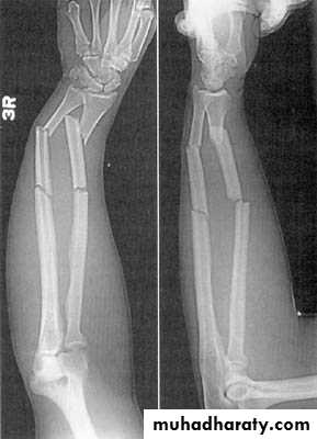 Introduction to Fractures