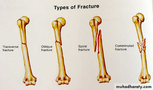 Introduction to Fractures