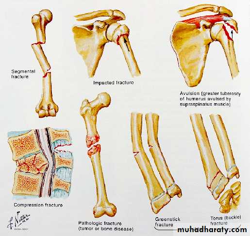 Introduction to Fractures