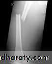 Introduction to Fractures