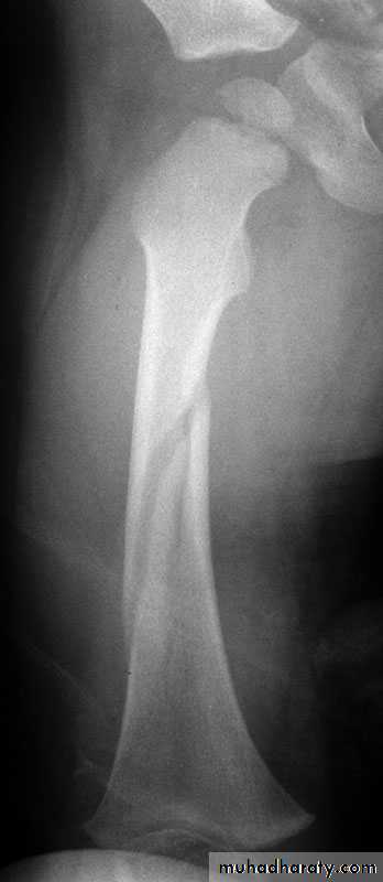 Introduction to Fractures