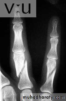 Introduction to Fractures