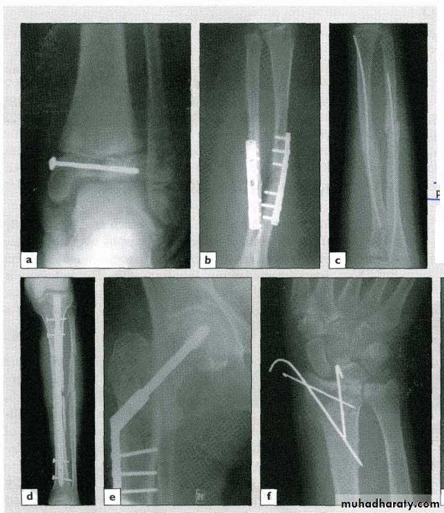 Management of Fractures