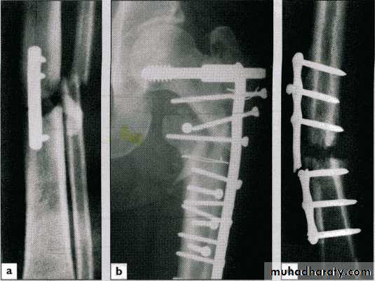 Management of Fractures