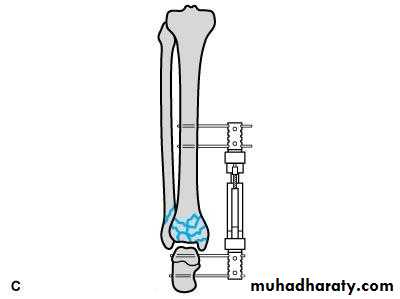 Management of Fractures