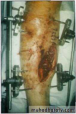 Management of Fractures