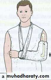 Management of Fractures