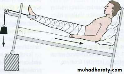 Management of Fractures