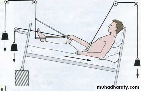 Management of Fractures