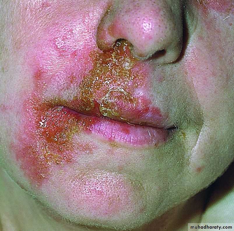 Bacterial Skin Infection
