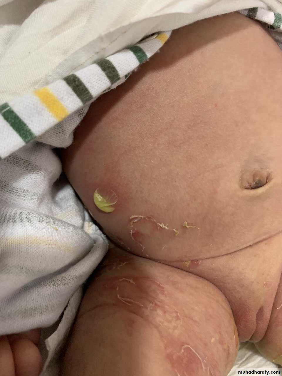 Bacterial Skin Infection