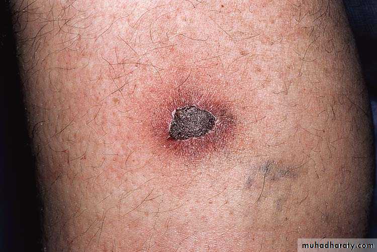 Bacterial Skin Infection
