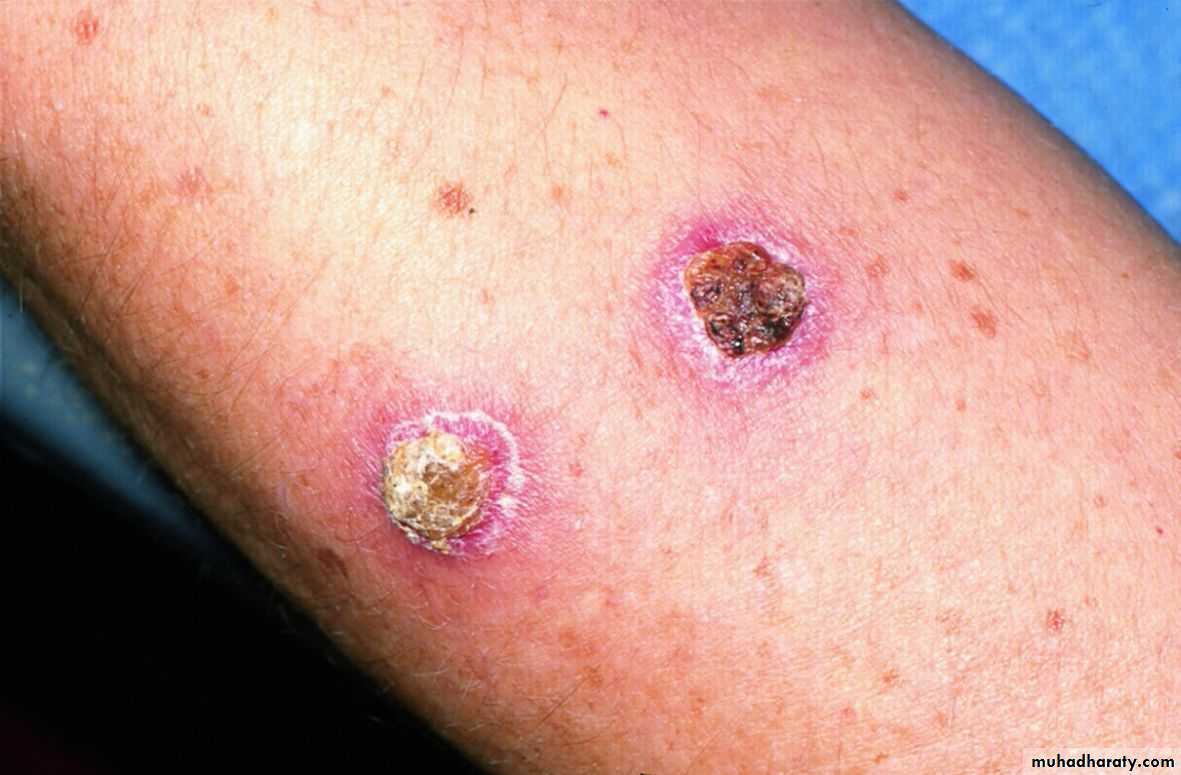 Bacterial Skin Infection