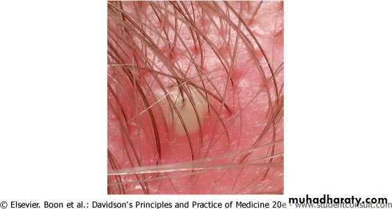 Bacterial Skin Infection
