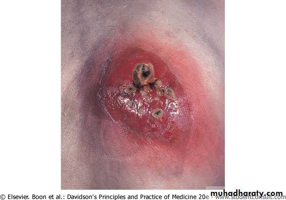 Bacterial Skin Infection