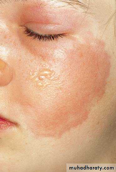Bacterial Skin Infection