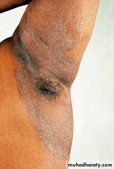 Bacterial Skin Infection