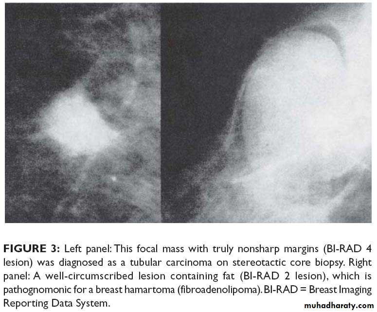 Breast