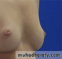 Breast