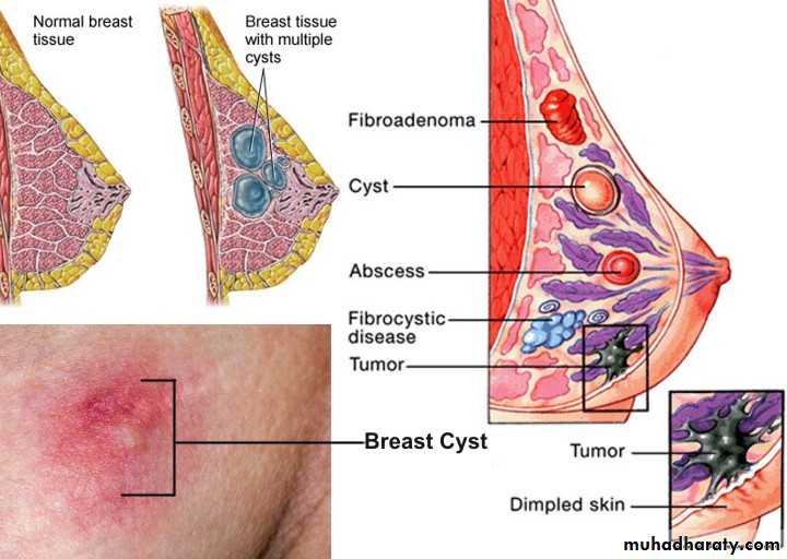 Breast