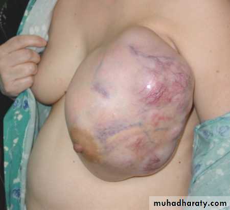 Breast