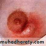 Breast
