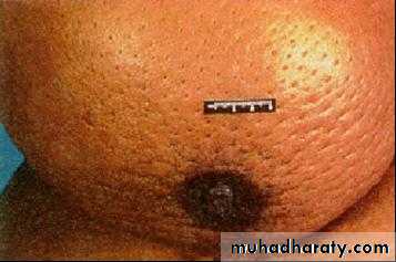 Breast