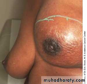 Breast