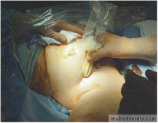 Breast