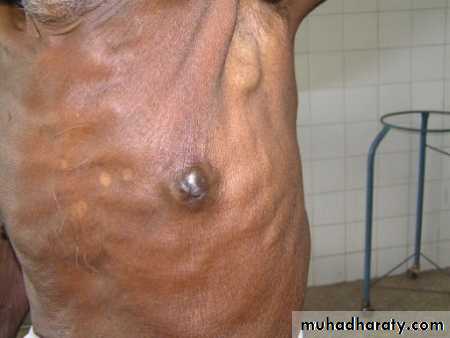 Breast