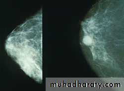 Breast