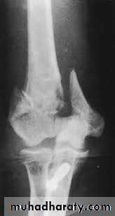 Elbow Injuries in Adult