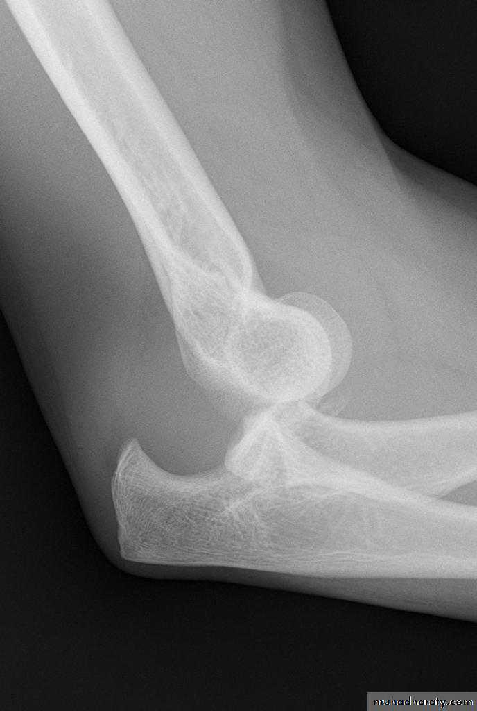 Elbow Injuries in Adult