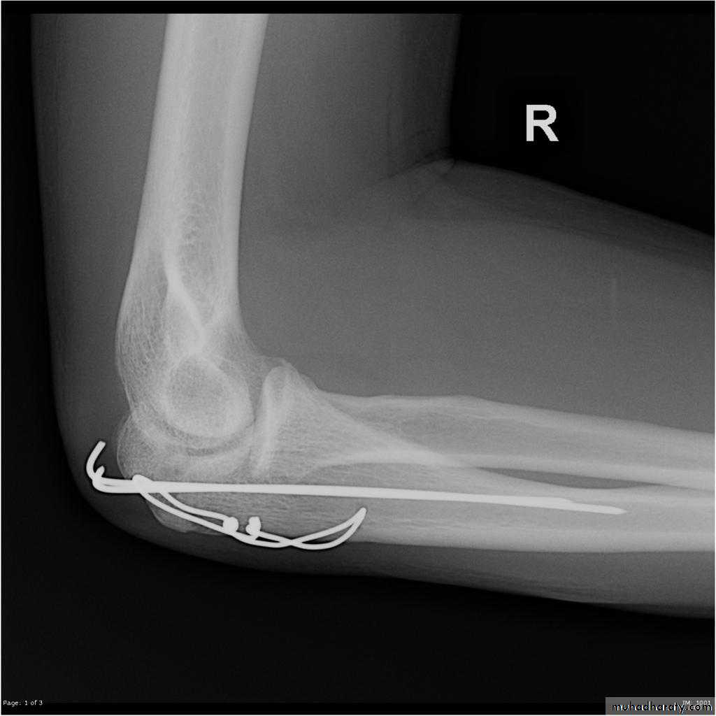 Elbow Injuries in Adult
