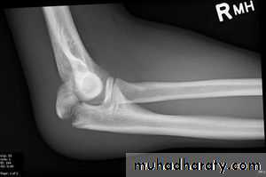 Elbow Injuries in Adult