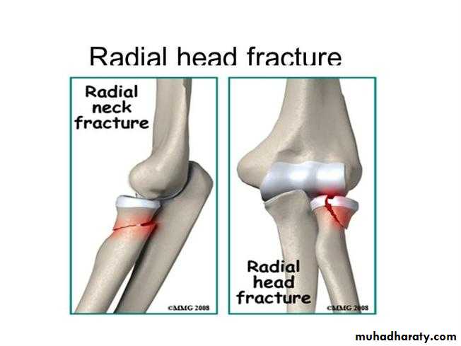 Elbow Injuries in Adult