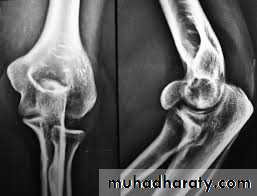 Elbow Injuries in Adult