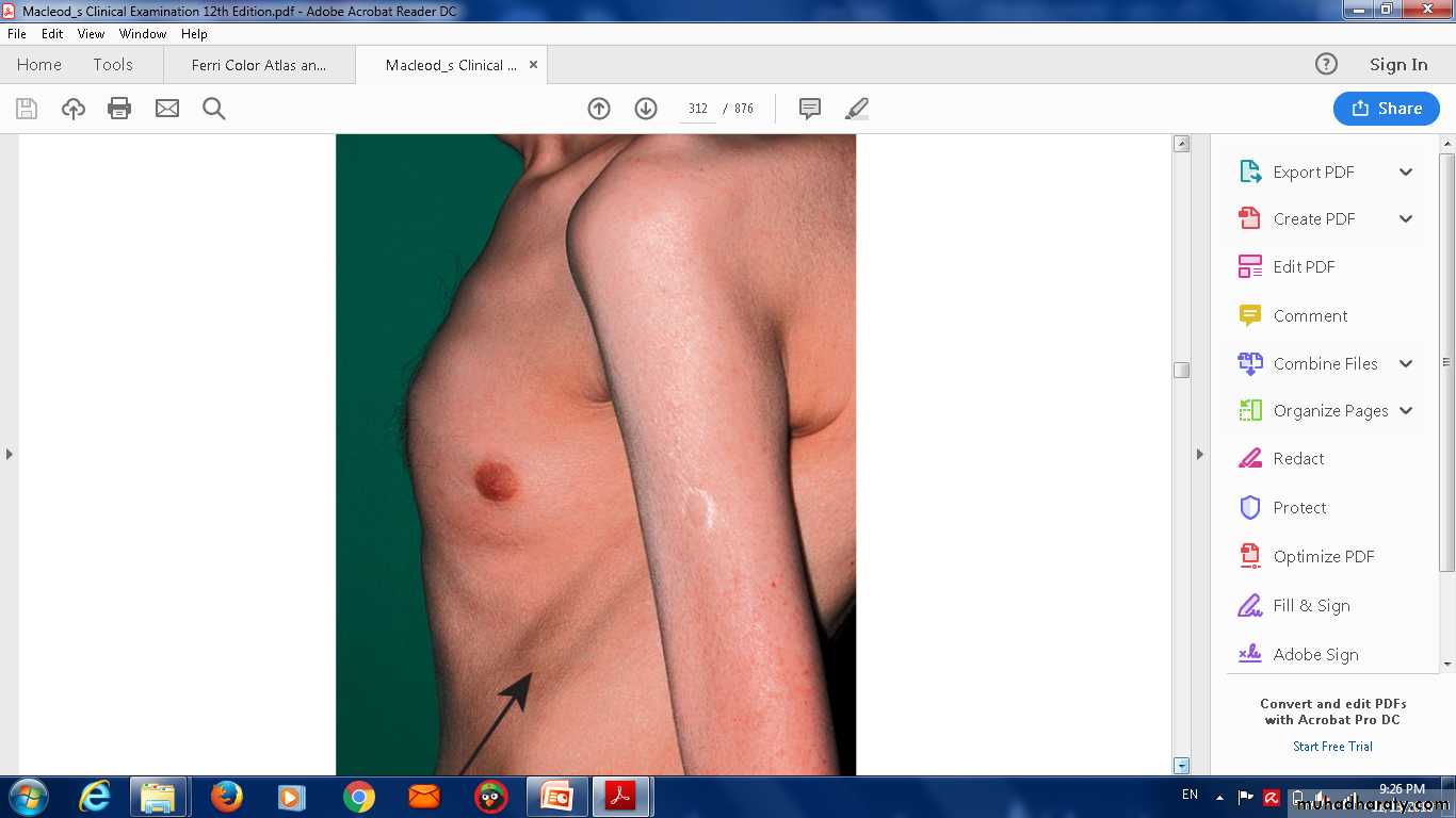 COPD