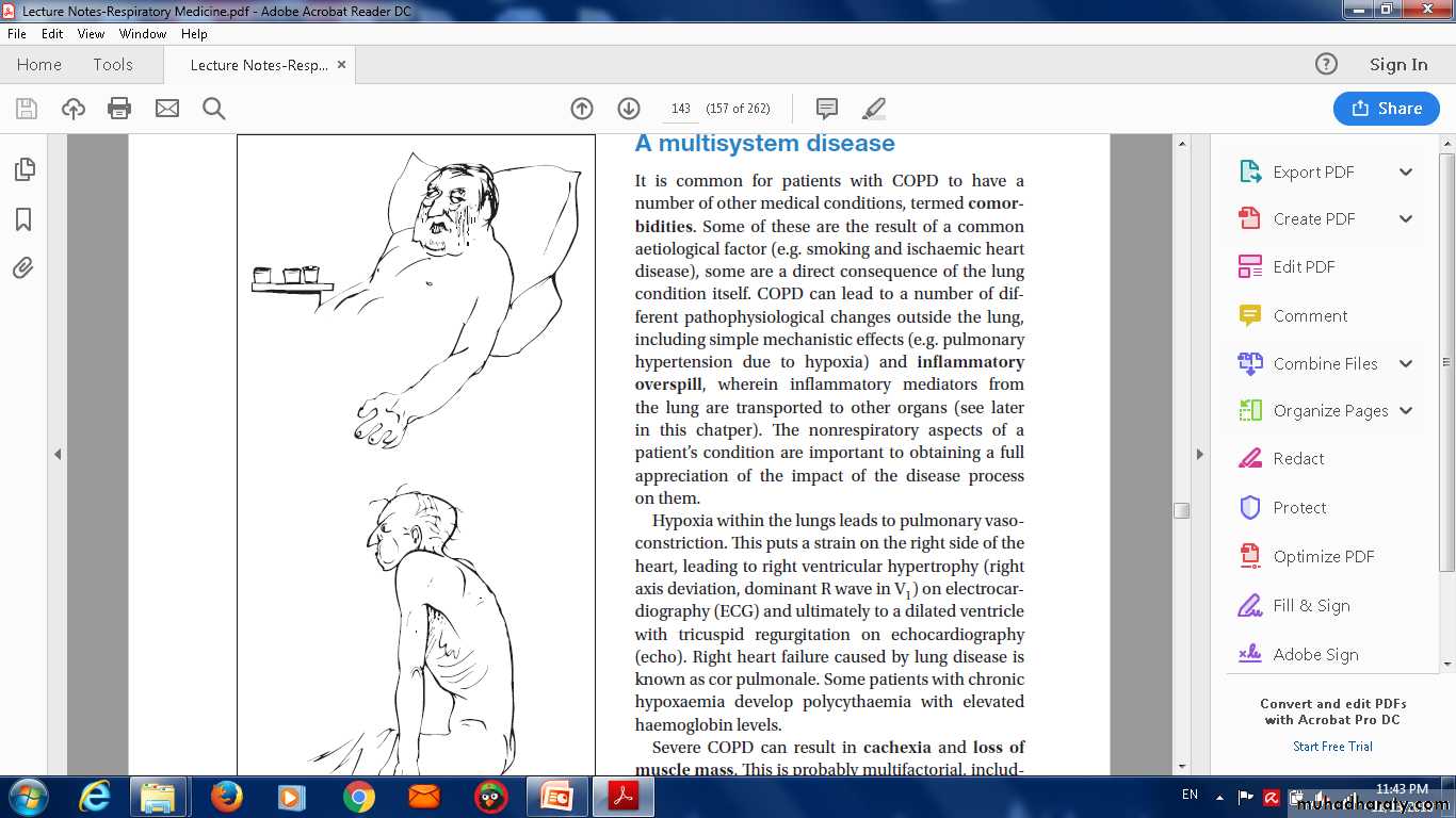 COPD