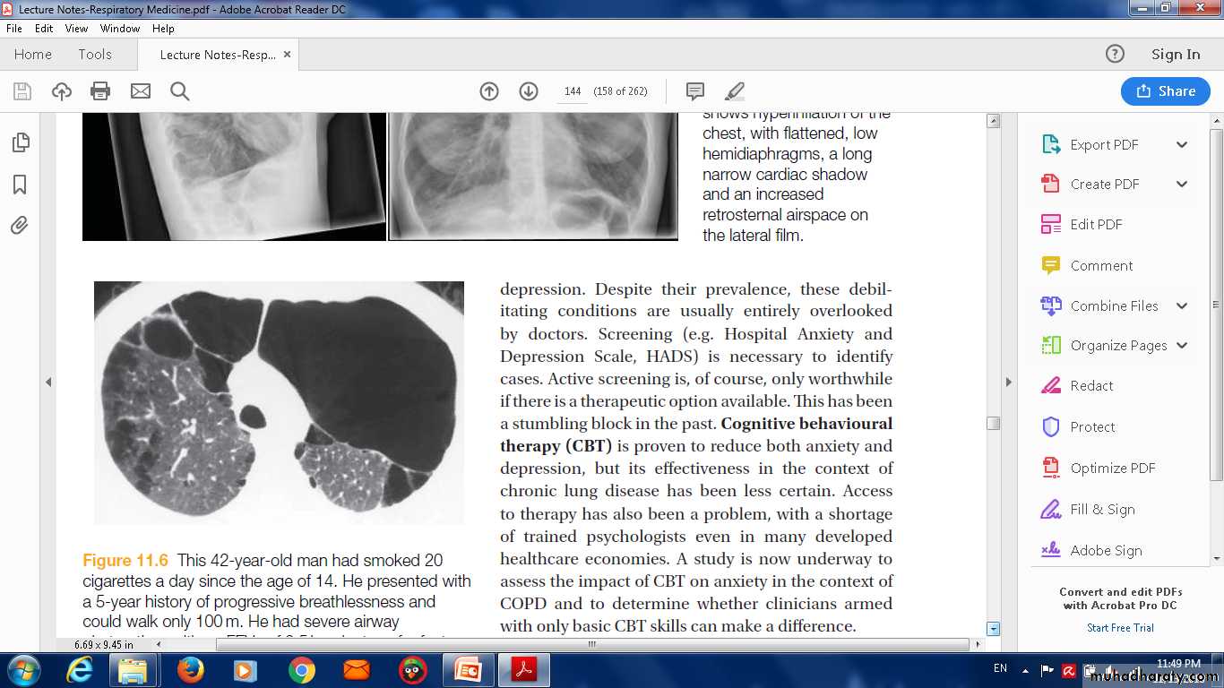 COPD