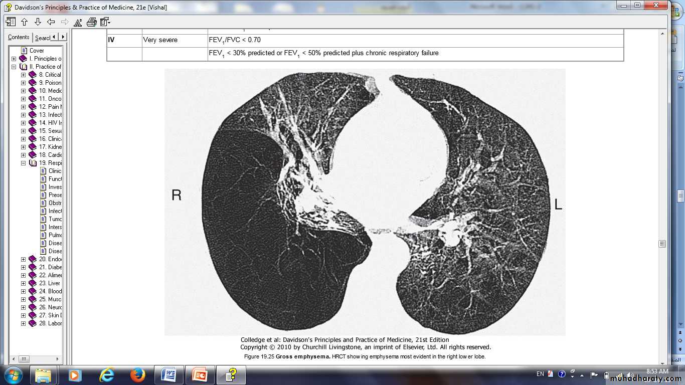 COPD