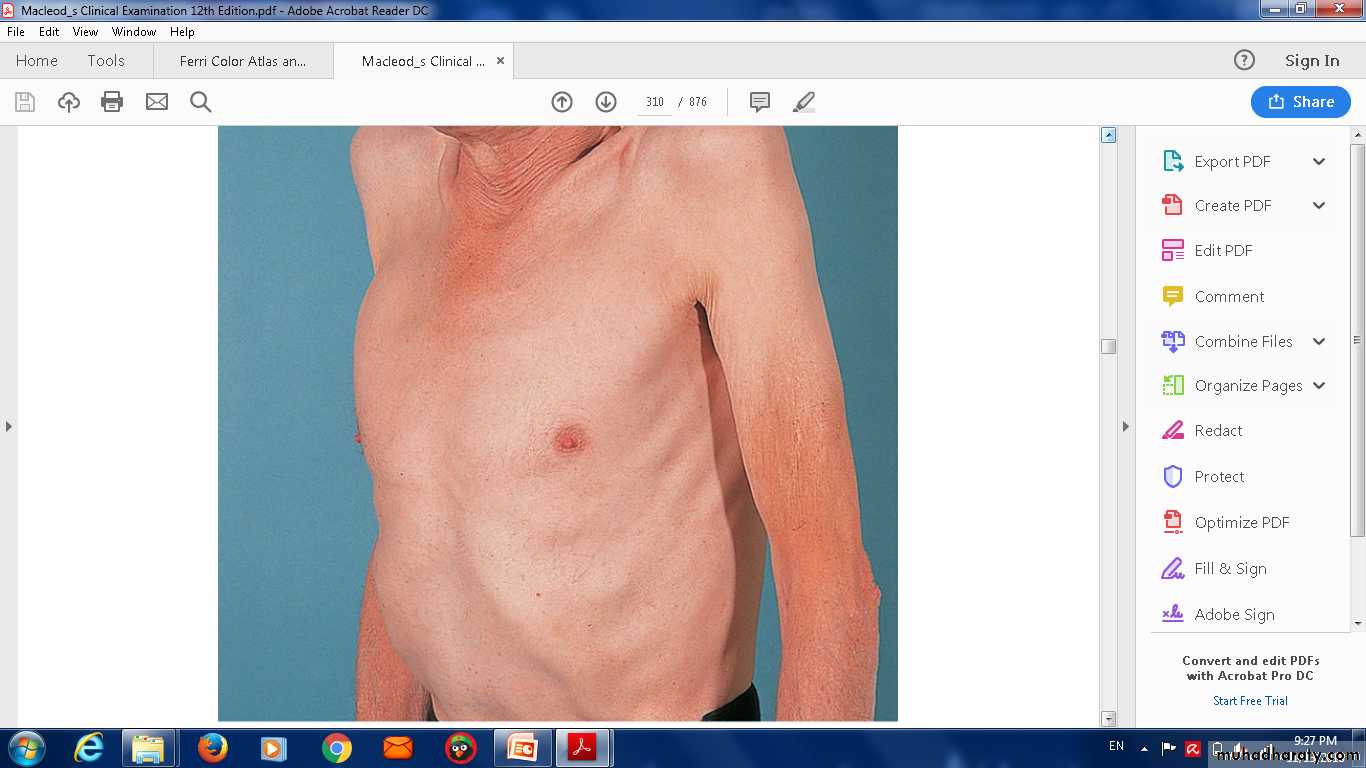 COPD