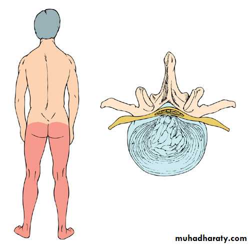 Back Pain