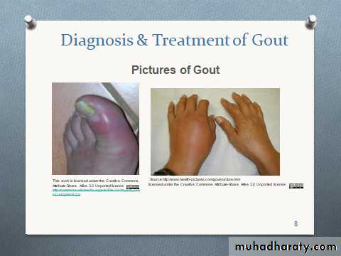 Gout