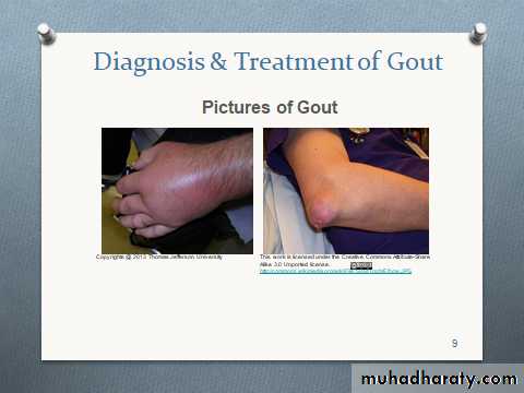 Gout