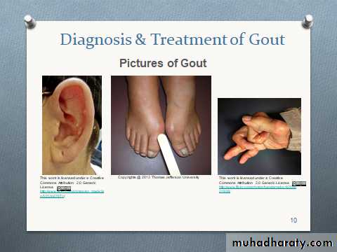 Gout