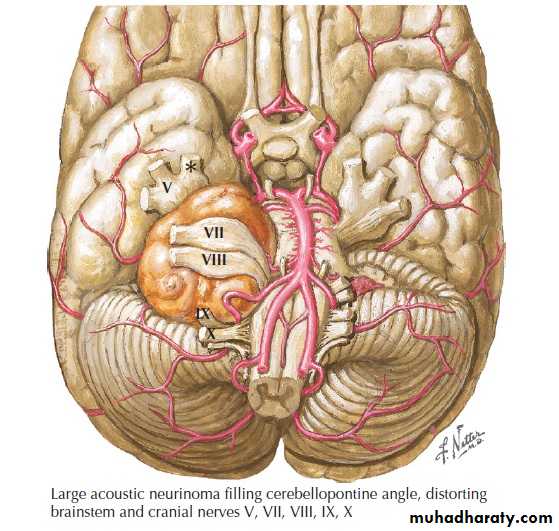 Cranial nerves disorders