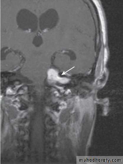 Cranial nerves disorders