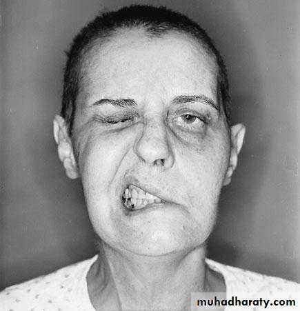Cranial nerves disorders